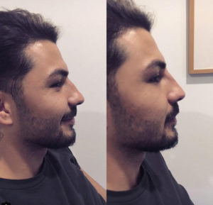Nasenkorrektur mit Hyaluronsäure