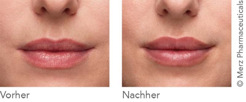 Das Bild zeigt Lippen nach einer Behandlung mit natürlichem Volumen.