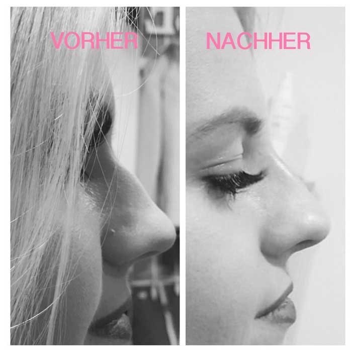 Das ist wichtig bei einer Nasenkorrektur mit Hyaluron – Dr. Steidl ...