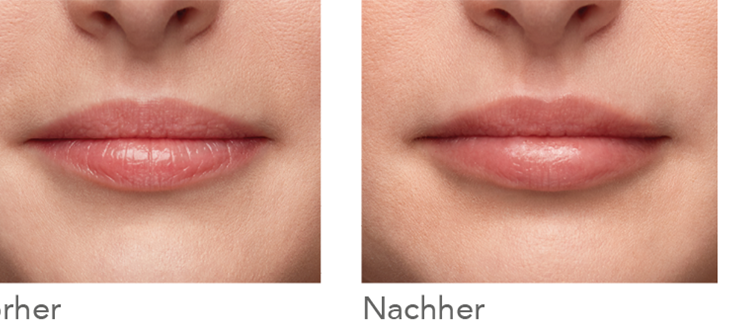 Lippenunterspritzung Dr Steidl Aesthetics