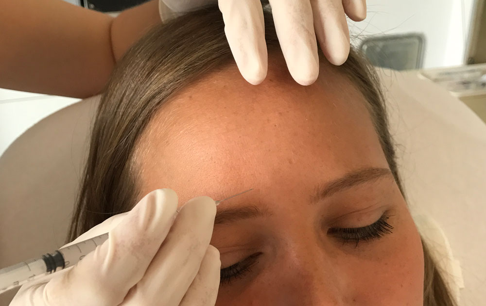 Behandlung der Stirn mit Botox